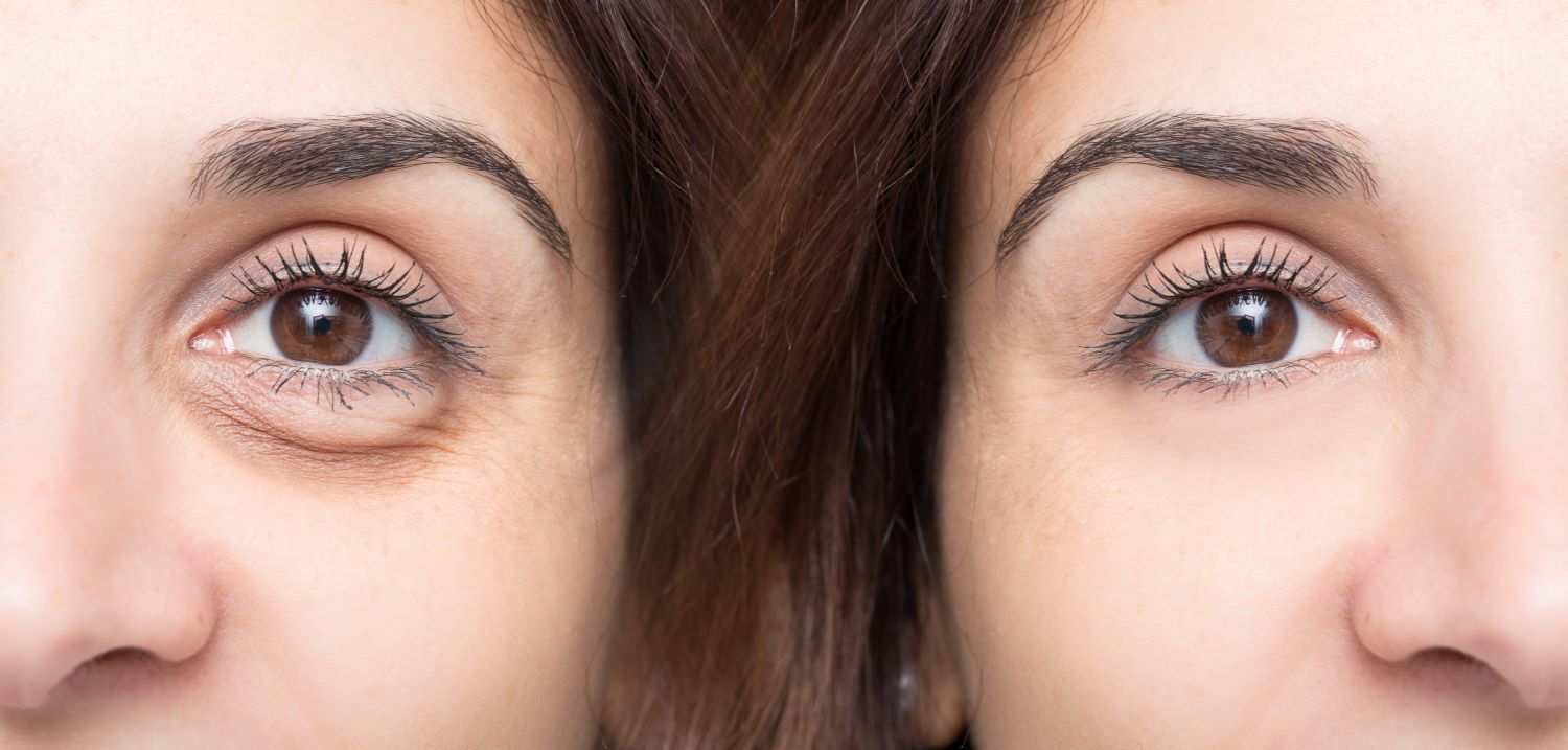 dermal fillers for under-eye