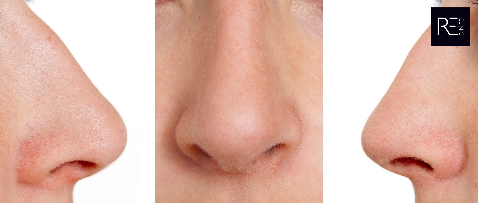 Droopy Nasal Tip