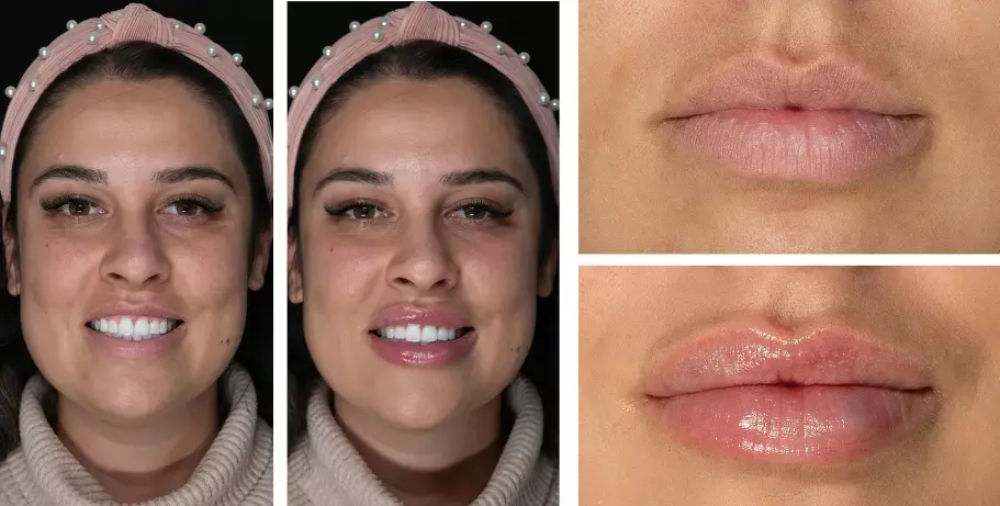 Before and after lip filler treatment using the 'fencing' technique