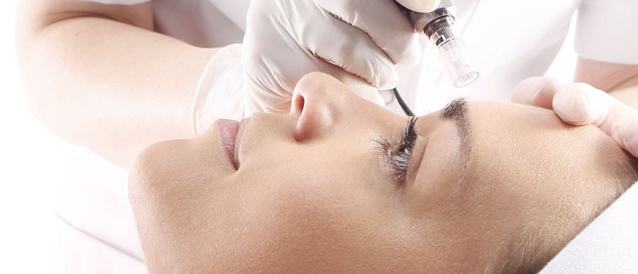 Microneedling